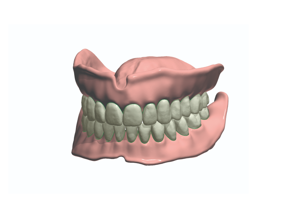 Digital Dentures
