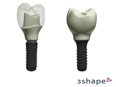IMPLANT CROWN DESIGN